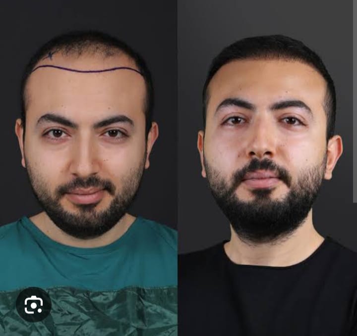 HAIR TRANSPLANT TREATMENT SERVICES