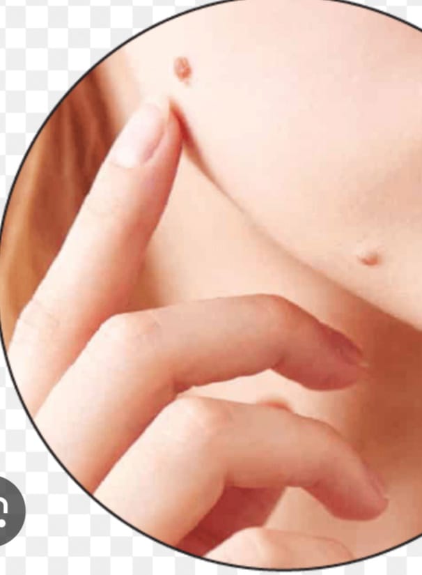 SKIN TAG AND WART REMOVAL TREATMENT BY BEST DERMATOLOGIST DR MEGHANA RANE