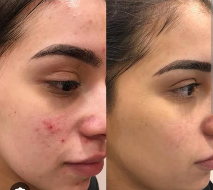 Acne scar skin treatment with best dermatologist i.e. Dr. Meghana Rane at andheri west mumbai