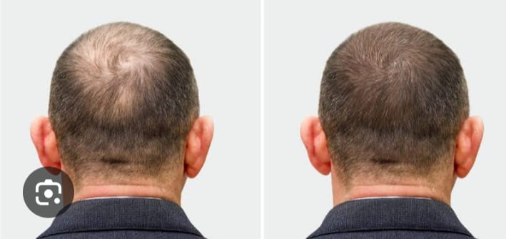 Hair transplant treatment services with best dermatologist Dr.Meghana Rane in andheri mumbai