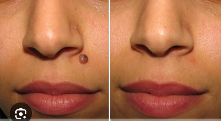 Mole removal treatment with best dermatologist i.e. Dr. Meghana Rane at Andheri west Mumbai