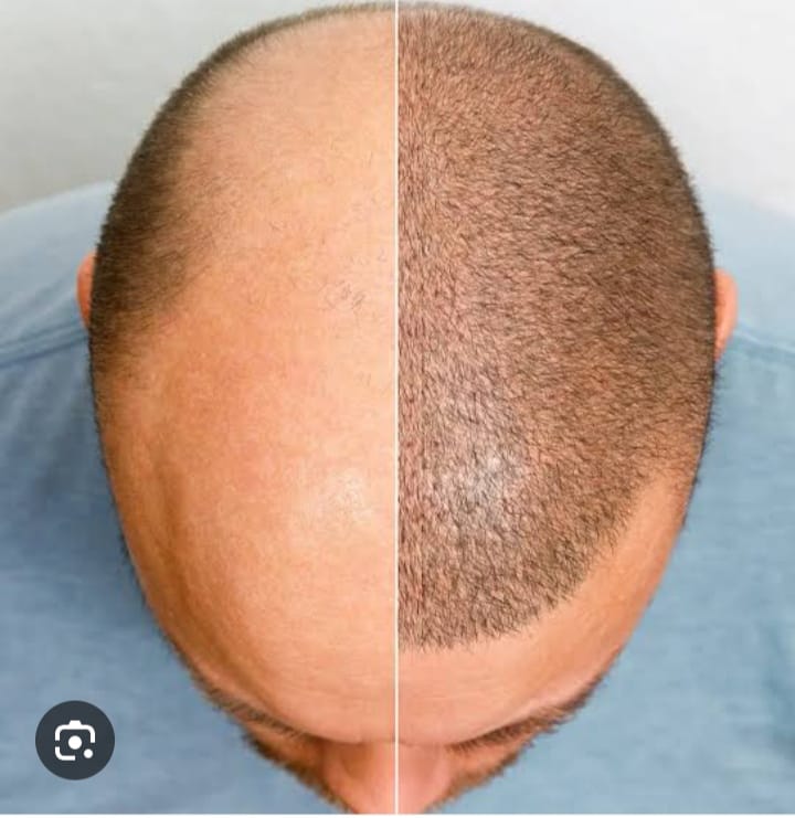 Best hair transplant treatment servcies with best drmatologist Dr. Meghana Rane in andheri west mumbai