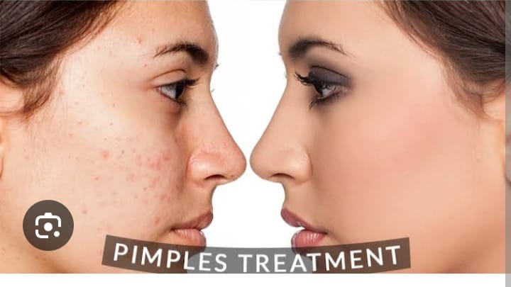 Acne  treatment services with best dermatologist Dr. Meghana Rane in andheri mumbai and in kandivali mumbai